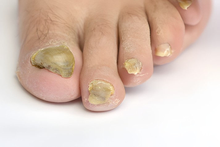 Nagelpilz an Zehennägeln – Behandlung bei MyBodyCare in Langwedel